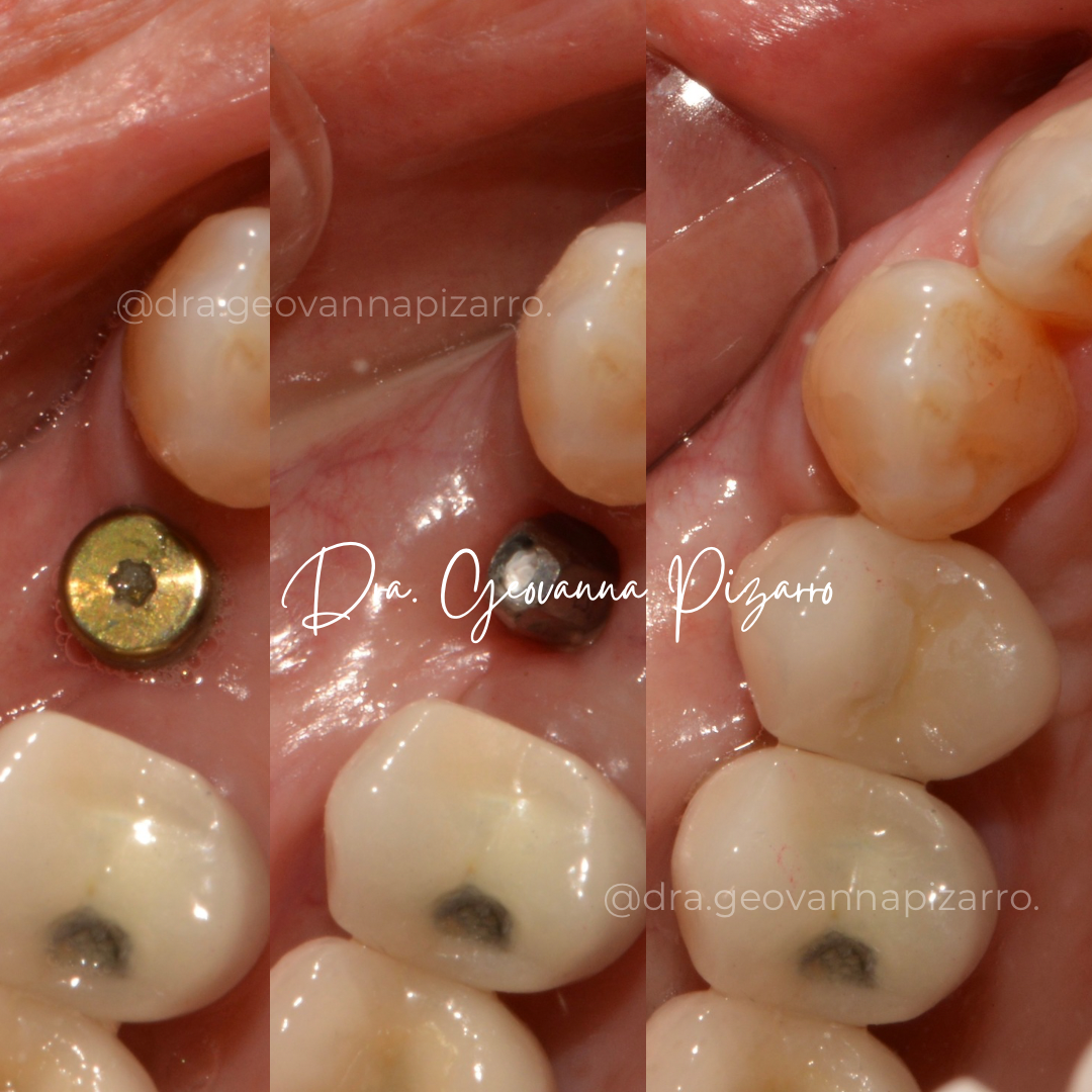 Estructura de un implante dental